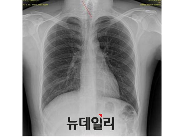 ▲공군에서 촬영한 박주신의 엑스레이상 제1흉추 극상돌기는 환자의 오른쪽으로 휘어져 있다. ⓒ 뉴데일리DB
