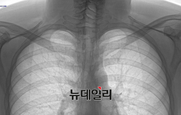 1. 박주신씨가 공군교육사령부에 입소해 촬영한 엑스레이. ⓒ모 의료인 커뮤니티 캡쳐