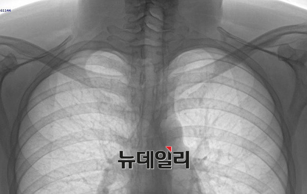 ▲ 1. 박주신씨가 공군교육사령부에 입소해 촬영한 엑스레이. ⓒ모 의료인 커뮤니티 캡쳐