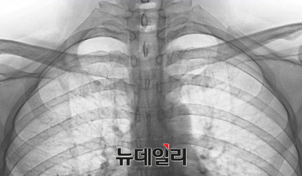 ▲ 2. 박주신씨 명의의 자생병원 엑스레이. ⓒ모 의료인 커뮤니티 캡쳐