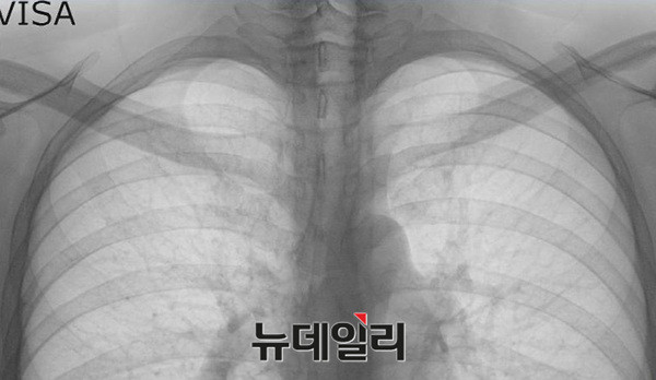 ▲ 3. 박주신씨가 영국출국용 비자를 발급받기 위해 세브란스병원에서 촬영한 엑스레이. ⓒ모 의료인 커뮤니티 캡쳐
