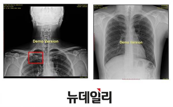▲박주신의 자생병원 X-Ray(왼쪽)과 공군 X-Ray(오른쪽). 자생병원의 엑스레이에서는 오른쪽 제1늑골부위에 '석회화'현상이 보이지만 공군엑스레이에선 보이지 않는다. ⓒ 뉴데일리DB
