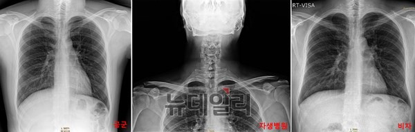 ▲ 문제의 X선 사진들. 맨 왼쪽은 공군 촬영본. 공군훈련소에서 촬영한 것으로 본인 것으로 추정된다. 가운데 사진이 자생한방병원에서 촬영해 병무청에 제출한 문제의 MRI 속 사진. 대리신검자의 것으로 추정된다. 맨 오른쪽 사진은 박주신이 영국 비자를 얻기 위해 촬영한 가장 최근 사진. 이 역시 박주신 본인 사진으로 보인다. ⓒ뉴데일리