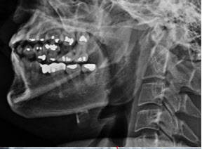 ▲ 박주신씨 명의의 자생병원 엑스레이 가운데 치아상태를 볼 수 있는 사진. ⓒ 뉴데일리DB