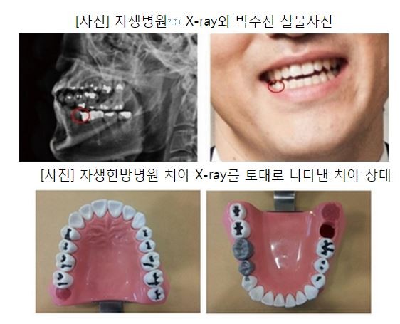 ▲ 박주신씨 명의의 치아 엑스레이 사진(사진 왼쪽 위), 박주신씨 실물사진(사진 위 오른쪽), 박주신씨 치아 엑스레이를 바탕으로 만든 치아 모형(사진 아래). ⓒ 뉴데일리DB