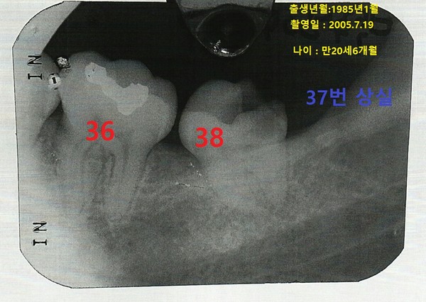 치과의사 문씨가 박주신을 촬영했다고 주장하며 검찰에 제출한 치근단 엑스레이 사진. ⓒ 차기환 변호사
