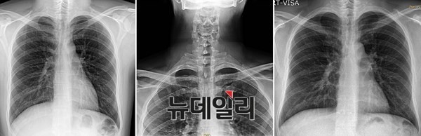 박주신씨 병역리비 의혹의 핵심 증거 중 하나인 주신씨 명의의 엑스레이 사진들. 왼쪽부터 공군훈련소 엑스레이(2011년 8월)-자생병원 엑스레이(2011년 12월)-비자발급용 엑스레이(2014년 7월). ⓒ 뉴데일리DB