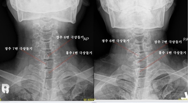 ▲ 최대집 의혁투 공동대표가, 엑스레이 촬영위치 및 각도의 차이에 따라 극상돌기의 방향이 다르게 보일 수 있는 지를 확인하기 위해 실험한 엑스레이 사진. 왼쪽은 AP(전-후면 사진), 오른쪽은 PA(후-전면 사진). ⓒ 최대집 대표 제공.