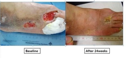 ▲ 버거씨병 환자의 썩어가는 발에 줄기세포 치료제를 투여한지 24주후의 변화ⓒ알바이오 제공