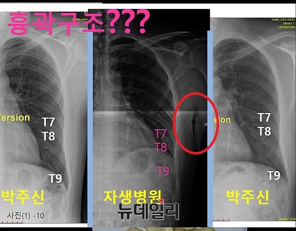 ▲ 박주신씨 명의 자생병원 엑스레이에서 발견되는 피부함몰 현상(붉은색 동그라미 부분). 남동기 전 교수는 이를 두고 몸무게 90kg 이상의 상당히 비대한 체형이라고 추정했다. ⓒ의료혁신투쟁위원회