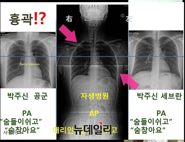 ▲ 남동기 전 교수는 박주신씨 명의의 엑스레이처럼, 호흡에 따른 흉곽의 모양이 크게 변할 수 없다는 사실을 실험을 통해 확인할 수 있었다고 밝혔다. ⓒ 의료혁신투쟁위원회