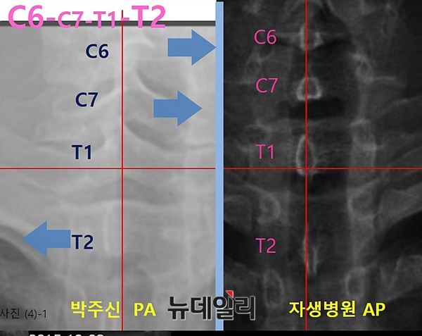 ▲ 3개월여 시차를 두고 촬영된 박주신씨 명의 공군 엑스레이와 자생병원 엑스레이. 극상돌기의 패턴이 불일치하고 있다. ⓒ 의료혁신투쟁위원회