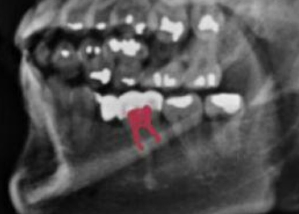 ▲ 45번 치아를 촬영한 치근단 엑스레이(위)와 자생병원 구외 엑스레이(아래). 구외 엑스레이에서는 치수가 다소 비대한 경증의 우상치 형태를 띠고 있으나, 치근단 엑스레이는 정상적인 치아의 모습을 보인다. ⓒ 제공 치과의사 김우현
