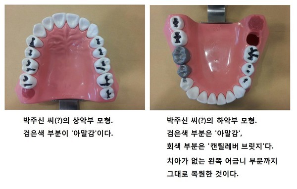 박주신씨를 치료했다고 주장한 치과의사 문00씨의 차트를 바탕으로 김우현 원장이 만든 치아모형. ⓒ 차기환 변호사