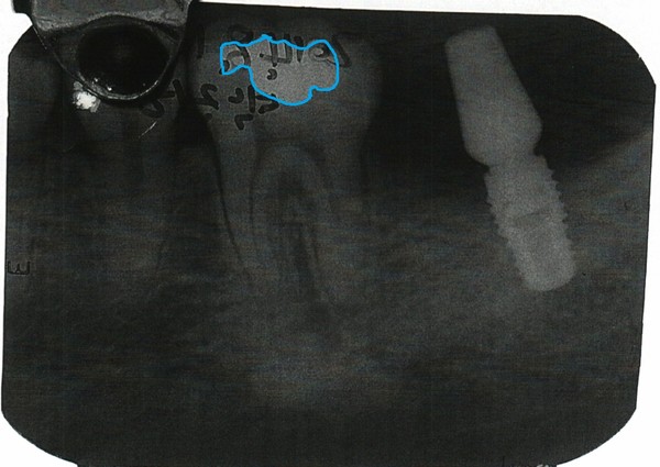 ▲ 치과의사 문씨가 주신씨를 치료한 증거로 검찰에 제출한 치근단 엑스레이 속 36번 치아의 아말감 형태. ⓒ 김우현 원장 제공