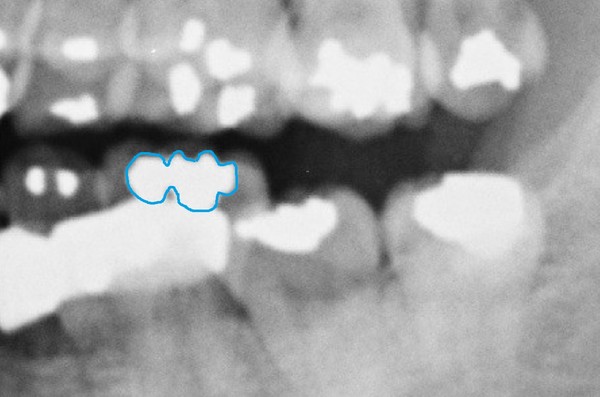 ▲ 김우현 원장은 박주신씨 명의의 치근단 엑스레이(위)와 자생병원 구외 엑스레이에서 보이는 36번 치아의 아말감 충전형태가 다르게 나타난다고 지적했다. ⓒ 김우현 원장 제공