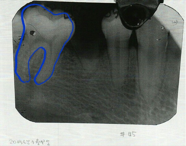 ▲ 김우현 원장은 박주신씨 명의의 치근단 엑스레이(위)와 자생병원 구외 엑스레이에서 보이는 36번 치아의 아말감 충전형태가 다르게 나타난다고 지적했다. ⓒ 김우현 원장 제공