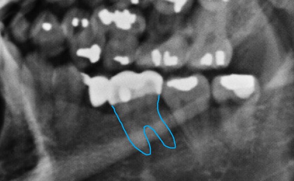▲ 박주신씨 명의의 치근단 엑스레이(위)와 자생병원 구외 엑스레이(아래). 김우현 원장은 36번 치아의 뿌리 부분 형태가 다르다고 설명했다. ⓒ 김우현 원장 제공