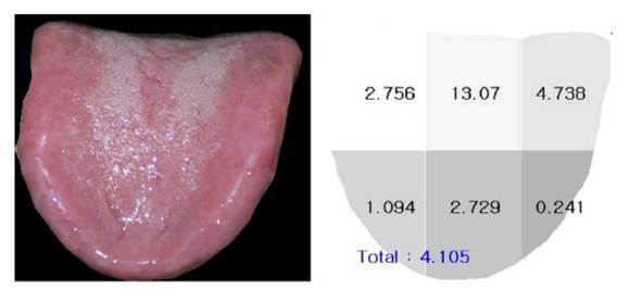 ▲ 디지털 설진기로 본 구강작열감 증후군 환자의 혀 사진.ⓒ경희의료원