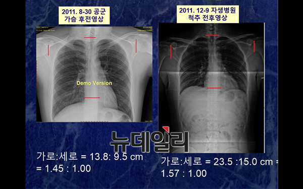 박주신씨 명의의 공군-자생병원 엑스레이에서 나타나는 흉곽 크기의 차이. ⓒ 차기환 변호사 제공