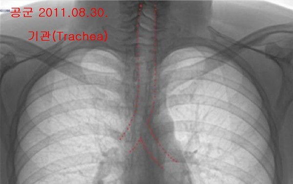 ▲ 박주신씨 명의의 공군-자생병원 엑스레이에서 나타나는 흉곽 크기의 차이. ⓒ 차기환 변호사 제공