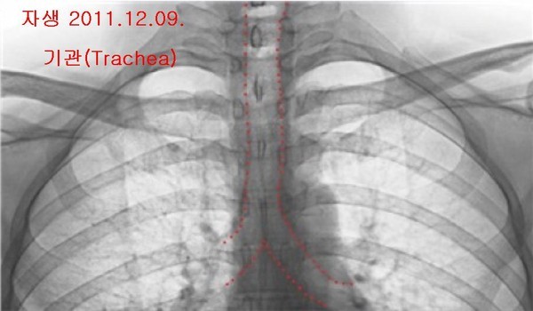 ▲ 박주신씨 명의의 공군-자생병원 엑스레이에서 나타나는 흉곽 크기의 차이. ⓒ 차기환 변호사 제공
