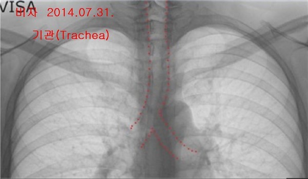 박주신씨 명의 엑스레이 3장에서 나타나는 기관(氣管)의 주행 형태. 자생병원 엑스레이는 직선으로 뻗어 있으나, 공군-비자발급용 엑스레이는 왼쪽으로 휘어있다. ⓒ 의료혁신투쟁위 제공