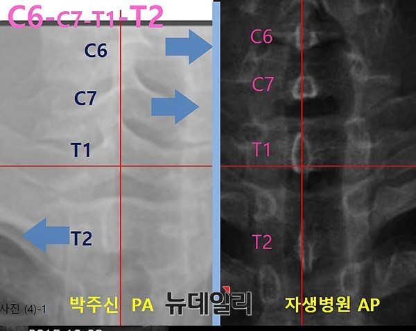 ▲ 박주신씨 명의의 공군(왼쪽)-자생병원(오른쪽) 엑스레이 상에 나타나는 극상돌기의 모습. ⓒ 의료혁신투쟁위 제공