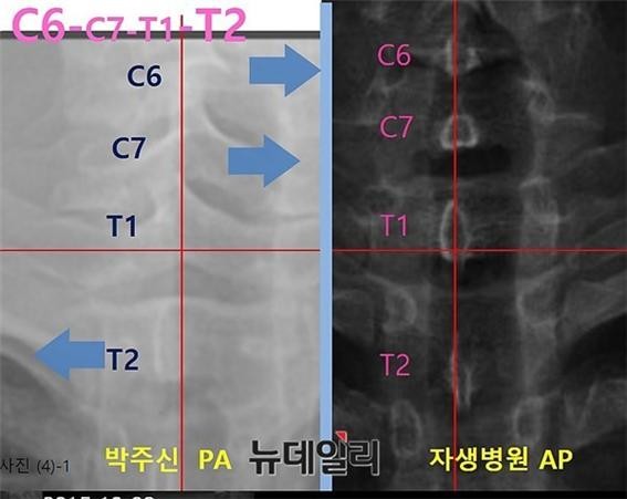 박주신씨 명의 공군 엑스레이(왼쪽)와 자생병원 엑스레이 상에 나타난 극상돌기 차이점. ⓒ 차기환 변호사 제공