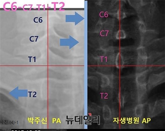 ▲ 박주신씨 명의 공군 엑스레이(왼쪽)와 자생병원 엑스레이 상에 나타난 극상돌기 차이점. ⓒ 차기환 변호사 제공