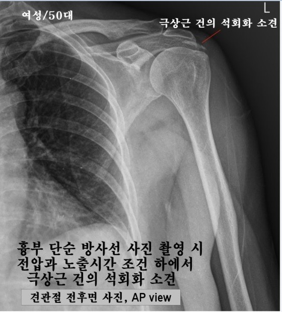 ▲ 최대집 의혁투 공동대표가, 엑스레이 촬영조건의 차이에 따라 석회화 현상이 보이지 않을 수 있다는 주장을 반박하기 위해 촬영한 엑스레이 사진. ⓒ 최대집 대표 제공