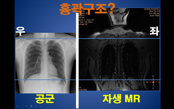 ▲ 남동기 전 아주대 교수는 박주신씨 명의 공군 엑스레이가 날씬한 체형인 반면, 자생MRI에서 나타나는 체형은 상당히 비대하다고 지적했다. ⓒ 남동기 전 아주대 교수-의혁투 제공