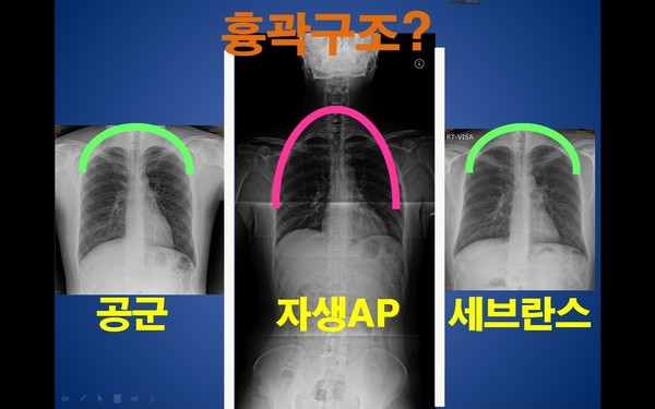 ▲ 박주신씨 명의 공군-자생-비자발급 엑스레이 비교에서 자생병원의 흉곽 모양만 다르게 나타나고 있다. ⓒ 남동기 전 아주대 교수