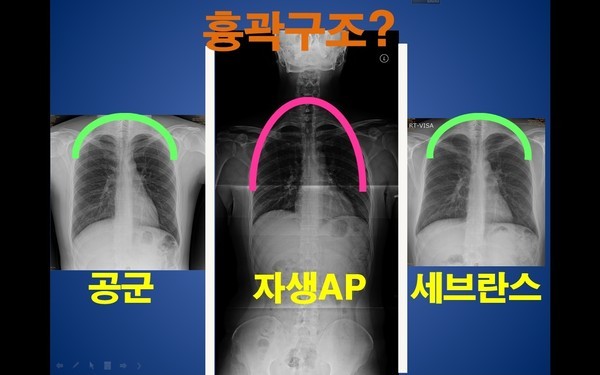 박주신씨 명의 공군-자생-비자발급 엑스레이 비교에서 자생병원의 흉곽 모양만 다르게 나타나고 있다. ⓒ 남동기 전 아주대 교수