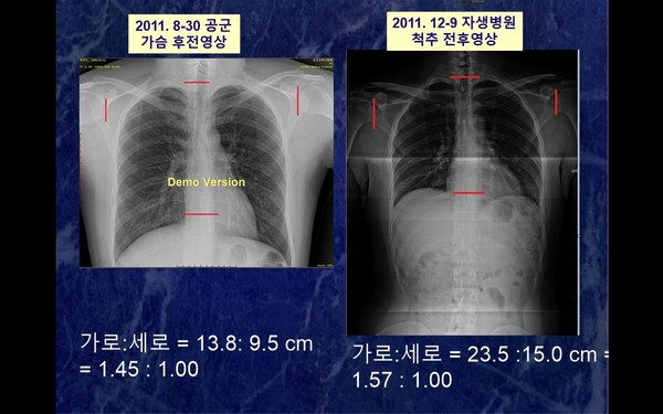 ▲ 박주신 명의 공군-자생병원 엑스레이의 골격 비율 차이. ⓒ남동기 전 아주대 교수