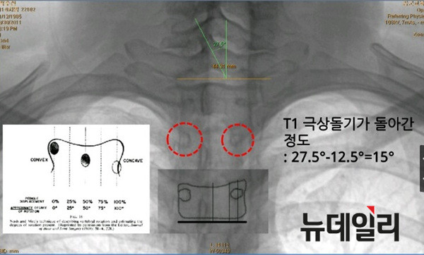 ▲ 변호인측 감정위원들이 '척추경'을 통한 측정으로 환산한 극상돌기의 휘어진 각도. ⓒ차기환 변호사