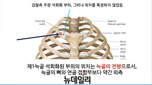 ▲ 주신씨 명의 자생병원 엑스레이에서 발견되는 석회화 현상의 위치. ⓒ차기환 변호사