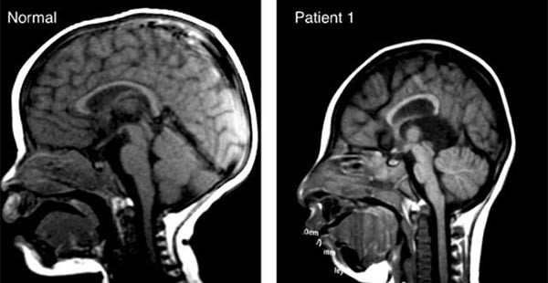 ▲ 일반인과 '소두증' 환자의 뇌구조 비교사진. ⓒ쿼츠닷컴 보도화면 캡쳐