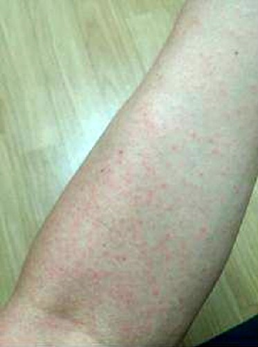 ▲ 한국인 첫 지카 바이러스 감염자의 팔에 나타난 발진 모습. ⓒ질병관리본부 제공