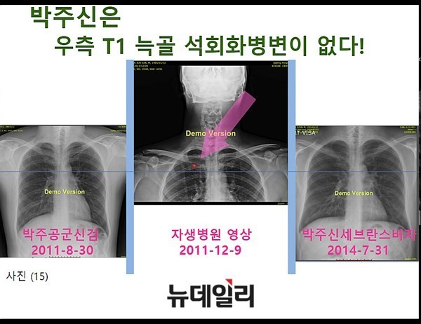 ▲ 남동기 전 교수는 "가슴을 필름면에 대고 찍는 방식으로 촬영된 공군훈련소·비자발급 엑스레이에서 석회화가 더 잘 나타나야 함에도 나타나지 않고, 오히려 그 반대로 촬영된 자생병원의 엑스레이에서만 석회화가 발견되고 있다"며 두 엑스레이 피사체는 동일인이 아닐 가능성이 매우 높다고 밝혔다. ⓒ 의료혁신투쟁위원회