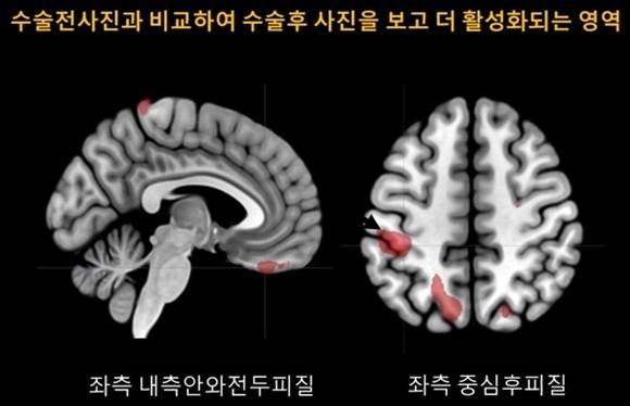 ▲ 양악수술 후 결과 만족도가 높은 환자는 좌측 내측안와전두피질과 좌측 중심후피질이 활성화됐다. ⓒ건국대병원