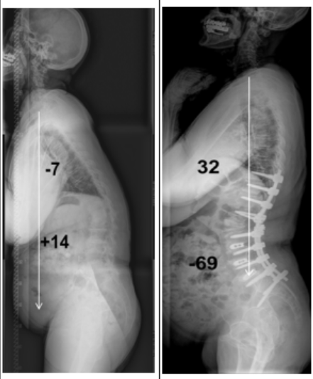 ▲ 60대 여성의 척추후만증 수술 전(왼쪽), 후 ⓒ경희의료원