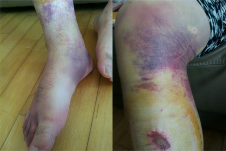 ▲ 부산대학교병원 정형외과 A교수에 의해 폭행을 당한 전공의 사진. ⓒ유은혜의원실