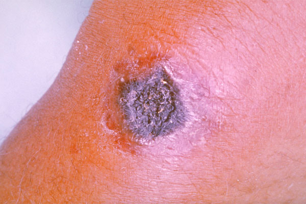 ▲ 탄저균에 감염된 피부가 괴사된 모습. ⓒ美질병통제센터(CDC) 공개사진.