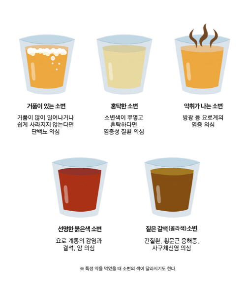 ▲ 소변 상태에 따른 건강상태 ⓒ이화의료원