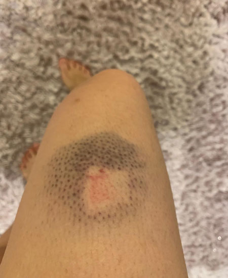 ▲ 경찰이 쏜 스폰지탄 (海綿彈) 에 피격당한 홍콩 모 TV 여기자의 다리 모습. 홍콩기자협회는 18일까지 총 24건의 기자 폭행 사례를 접수했다고 밝혔지만, 이 여기자의 피격사례는 보고되지 않았다. ⓒ피격 여기자 제공