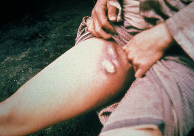 ▲ 페스트 가운데 가래톳 페스트에 감염된 환자. ⓒ美질병통제센터(CDC) 공개사진.
