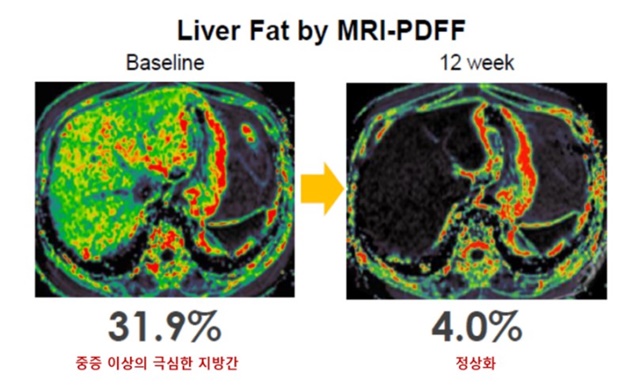 ▲ MRI-PDFF 검사로 확인한 지방간 감소 효과 ⓒ한미약품
