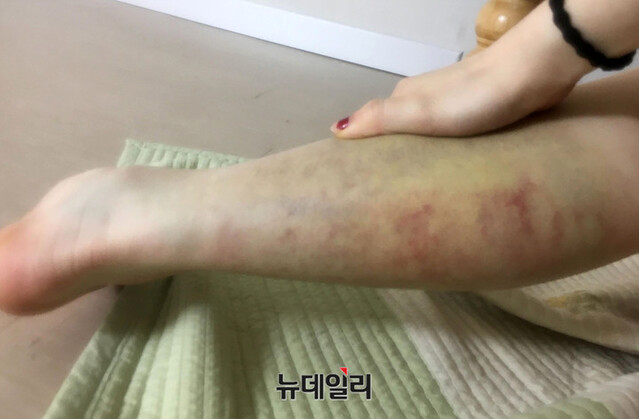 ▲ '맞방(맞는방송)'에서 폭행당해 시퍼렇게 멍이 든 피해자의 종아리. ⓒ뉴데일리 DB