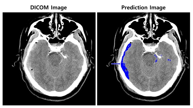▲ 뇌출혈이 의심되는 환자의 뇌 CT 영상(왼쪽)과 뇌출혈 영상 판독 AI 모델이 출혈 병변(화살표) 존재와 위치를 식별한 영상. ⓒSK㈜ C&C